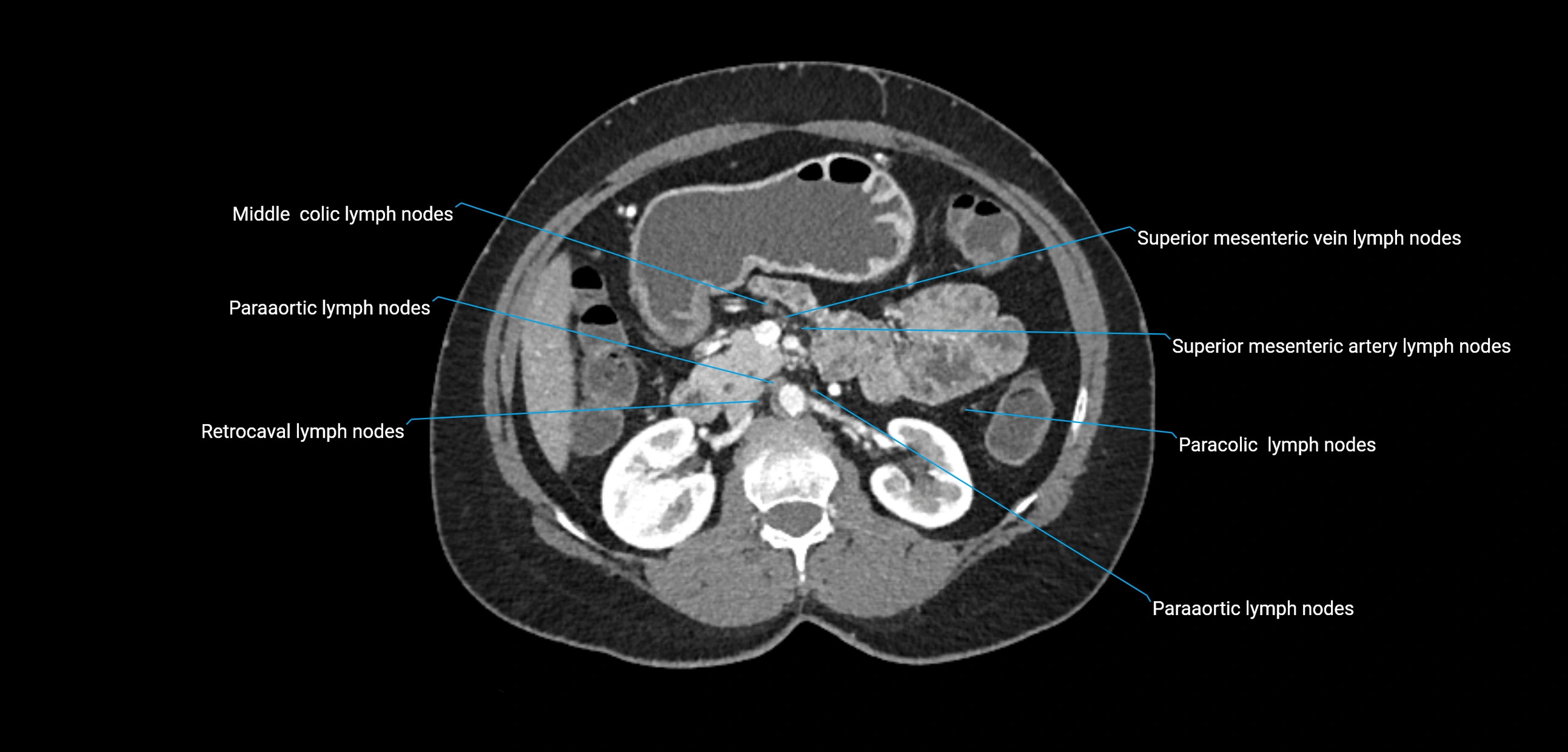 CT ct abdominal lymph nodes  axial cross sectional anatomy  enchanced radiology image -img-00002-00181.webp
